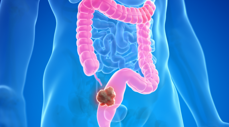 SUS implementa novo teste caseiro para rastreamento precoce do câncer colorretal no Brasil com tecnologia avançada de detecção de sangue oculto