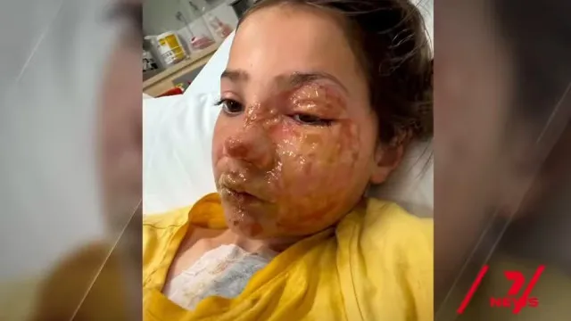 Menina de 10 anos fica com queimaduras no rosto após participar de desafio do TikTok